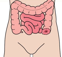 Colostomi Colostomi