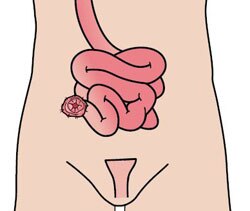 Ileostomi Ileostomi