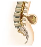 Illustrasjon på Spina Bifida Myelomeningocele