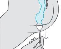 Fjerne analpropp