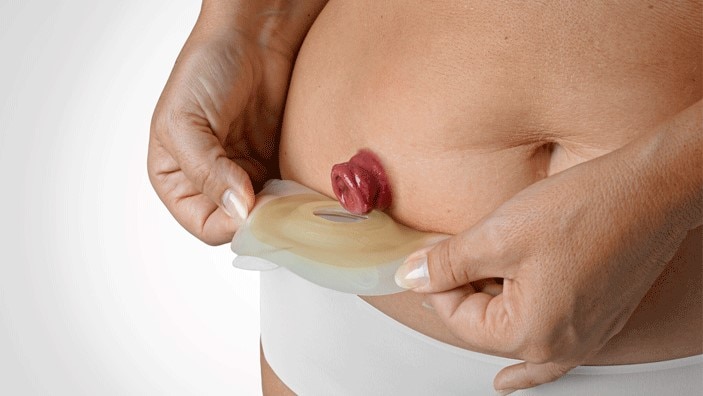 Bilde av en mage med stomi og en hudplate som legges på